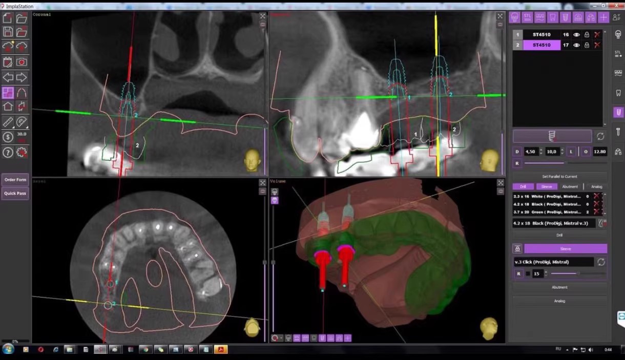 ImplaStation 5.3 免狗版一机一码注册版导板设计与牙科植入规划工具060228【】