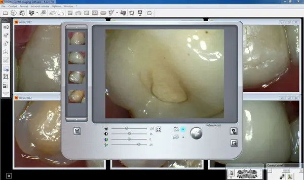 KODAK Dental Imaging Software 6.12.11 加密狗版柯达牙科影像软件060255